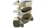 spinal disc implant