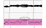 A chart recording showing a region with too wide a variation in wall thickness.