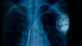 Pacemaker cell x-ray image